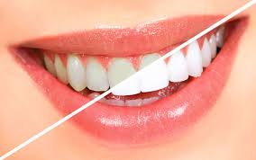 Teeth Whitening - In-Office